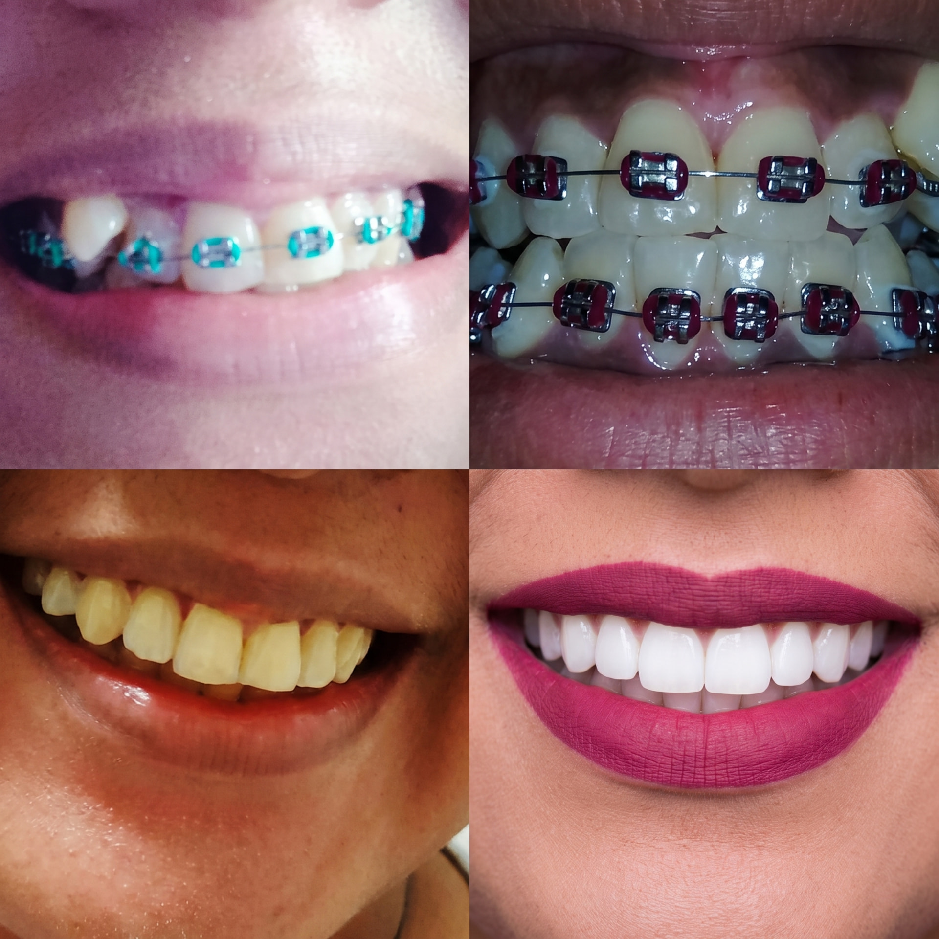 Registro visual de sorrisos e aparelhos odontológicos